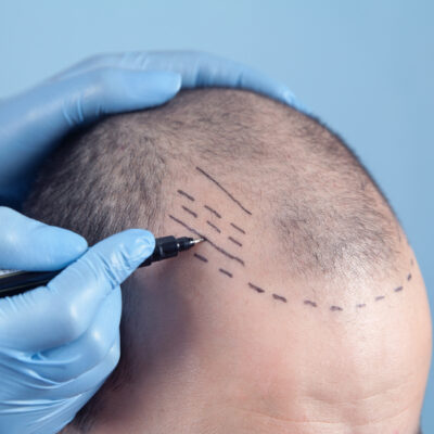 5 Benefits of Getting a Hair Transplant in 2022